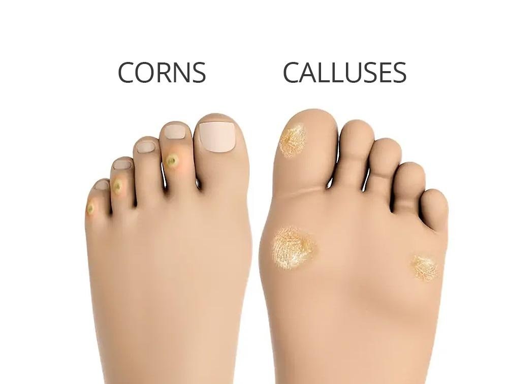20220131-0859417-Facts-About-Corns-and-Calluses-That-You-Should-Know-About