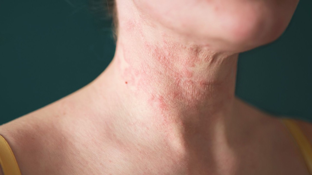 6-Main-Types-of-Eczema-You-Might-Not-Know
