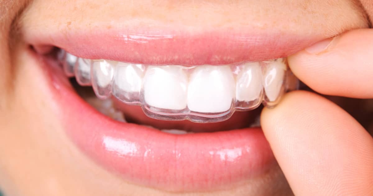 5-Common-Dental-Conditions-That-Can-Be-Managed-With-Invisalign
