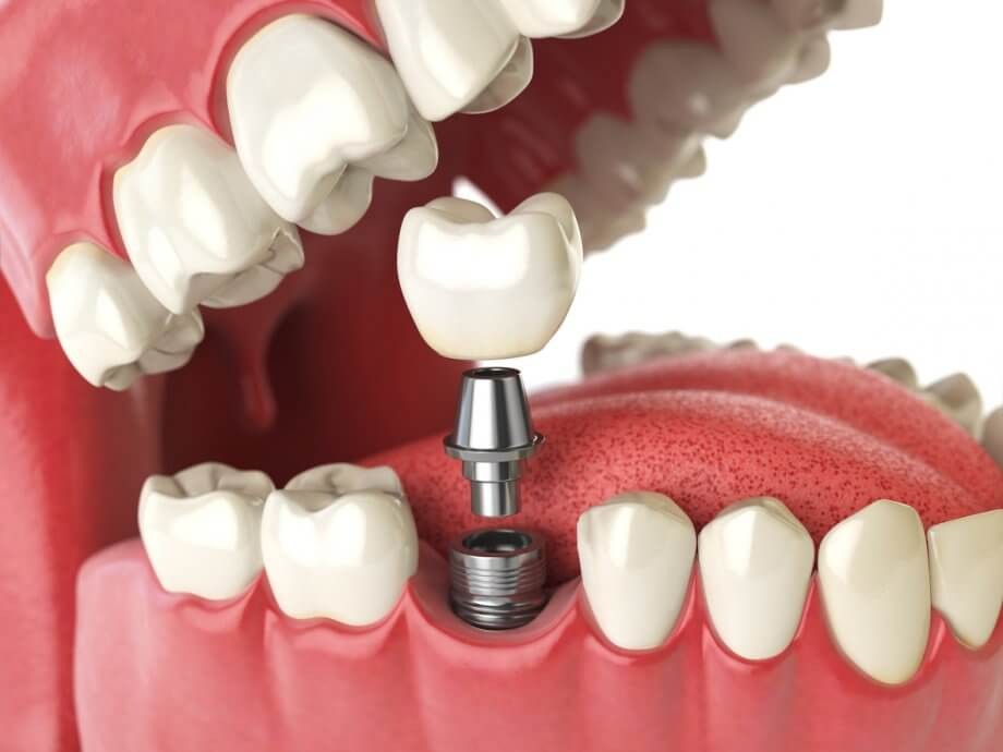 Why Are Dental Implants the Best Option to Restore the Missing Teeth?