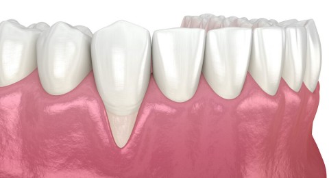 9 Common Causes of Gum Recession and Ways to Prevent Them