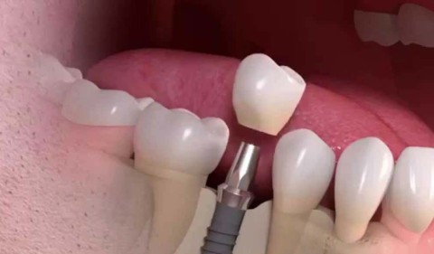 What to Do if Your Dental Implant Fell Out